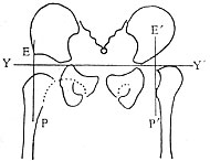 ep,e′p′=perkin线;虚线=shenton线(健侧相连续)(二)髋臼指数  自y形