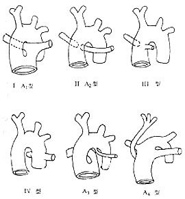 根据肺动脉起源部位的不同,永存动脉干有数种分型方法.