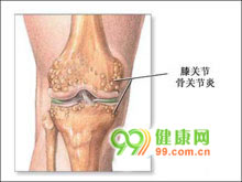 色素绒毛结节性滑膜炎