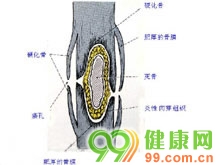 慢性化脓性骨髓炎