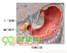 特发性胃肠道嗜酸性细胞浸润综合征