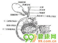 胰胆管合流异常综合征