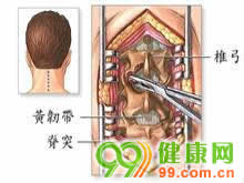 颈椎椎弓裂