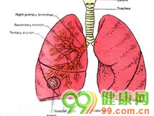 特发性肺纤维化