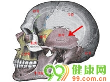 颞骨骨折