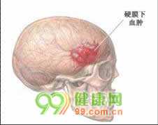 急性和亚急性硬脑膜下血肿