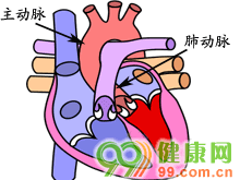 主-肺动脉隔缺损