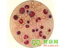 营养性巨幼红细胞性贫血
