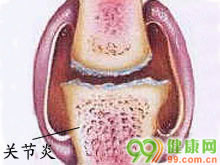 系统性红斑狼疮性关节炎