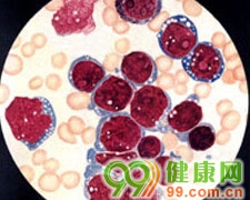 急性淋巴细胞性白血病