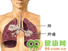 肺转移瘤