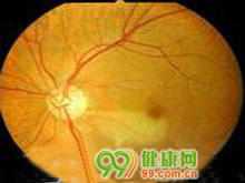 视网膜动脉阻塞