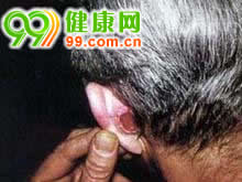 耳部恶性肿瘤