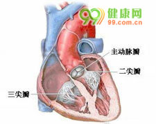 心肌梗塞并发二尖瓣关闭不全