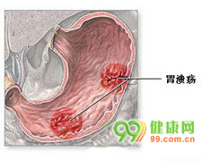 药物性胃病