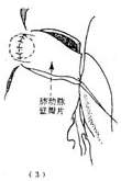 冠状动脉异位起源