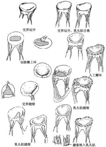 先天性二尖瓣畸形