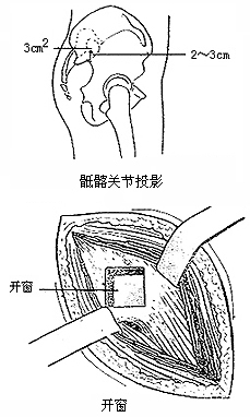 骶髂关节结核