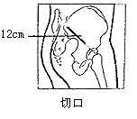 骶髂关节结核