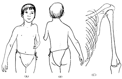 先天性肩关节脱位