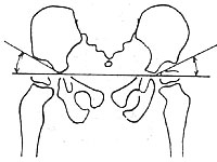 图6  髋臼指数测量法(三)骨骺外移测定  自股骨头骨骺中心至耻骨联合