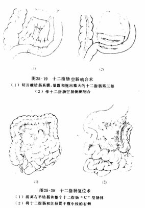 十二指肠血管性压迫综合征