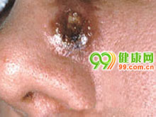 鼻疖肿蜂窝组织炎图片